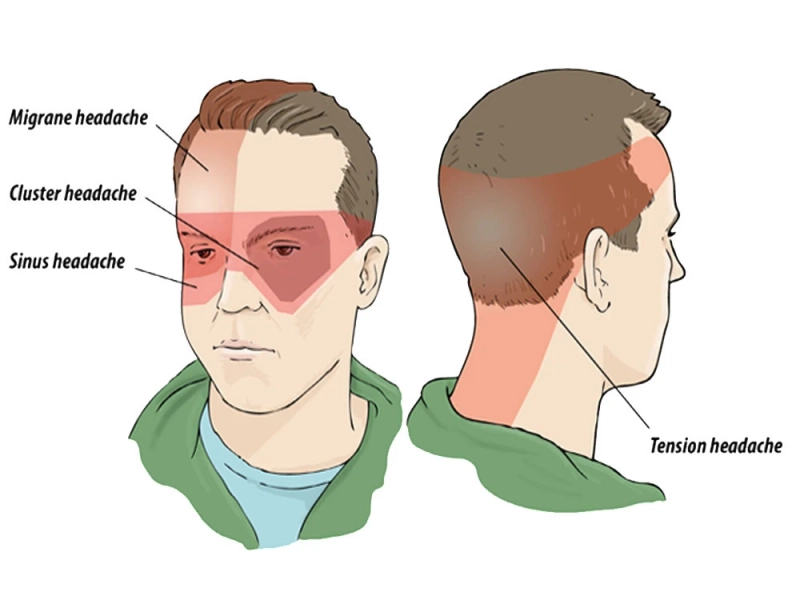 There Is An Associated Stuffy Nose, Tearing Of The Eyes, And Drooping Eyelids With Cluster Headaches