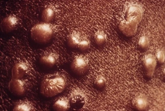 Global Smallpox Treatment Market Is Estimated To Witness High Growth Owing To Innovative Therapies
