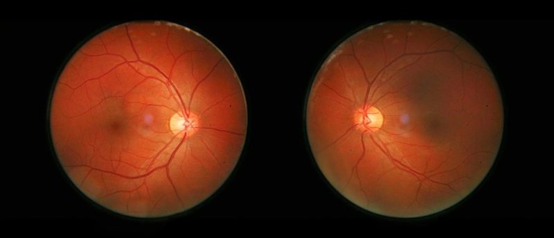 Retinal Disease Therapeutics Market Trends: Size and Share Analysis