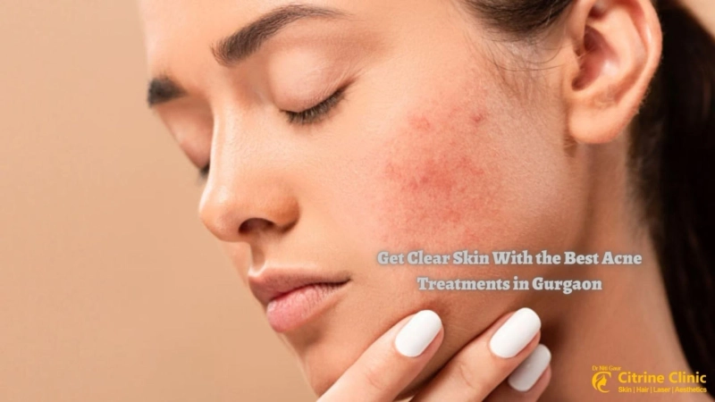 Get Clear Skin With the Best Acne Treatments in Gurgaon