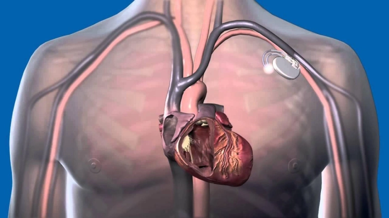 Implantable Cardiac Pacemaker Are Medical Devices Used For Proper Heart Function