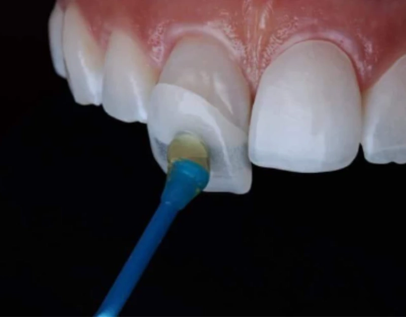 How To Fix Your Crooked Yellow Teeth Instantly?