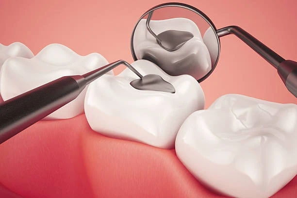 Composite Fillings: A Natural-Looking, Tooth-Preserving Option