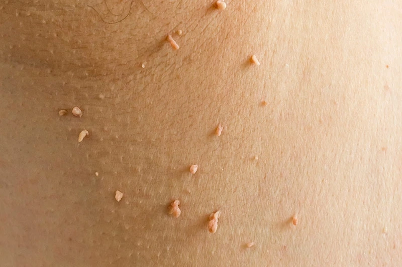 Do Skin Tags Spread? Key Facts to Know