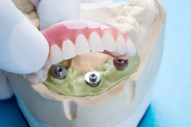 Implant Dentures: A Guide to Stability, Comfort, and Lasting Results