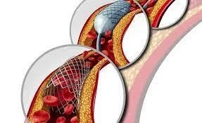 The Power of Primary Angioplasty in Treating Heart Attacks