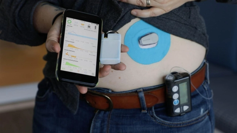 Artificial Pancreas Device Systems Market Outlook, Growth, Demand and Size by 2028