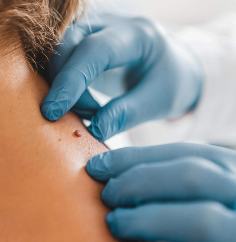 Erase the Bumps: Warts Removal in Dubai Demystified