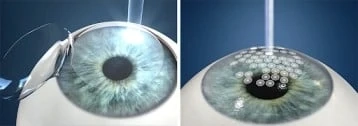 Is LASIK allowed in Indian Air Force?