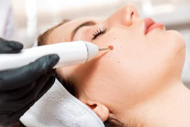 Laser Mole Removal: Safe, Painless, and Effective