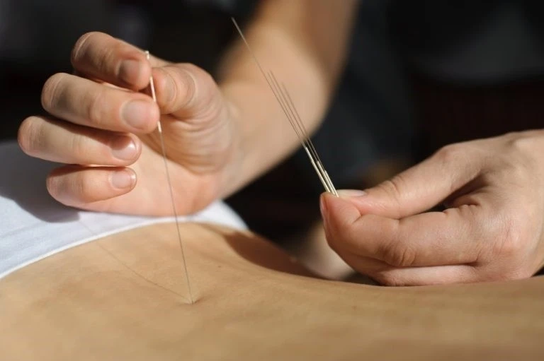 The Benefits of Acupuncture for pain relief and improved quality of life