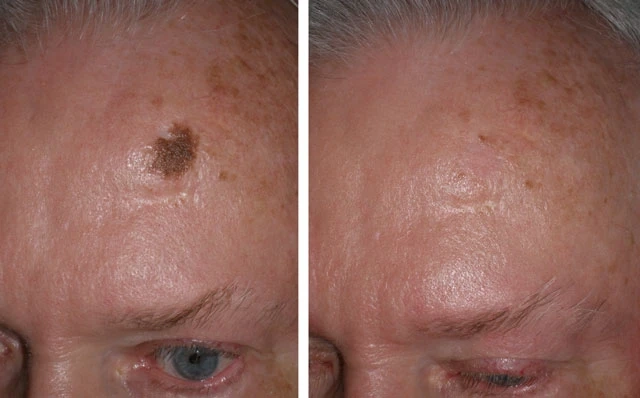 Private Mole Removal Cost: What You Need to Know