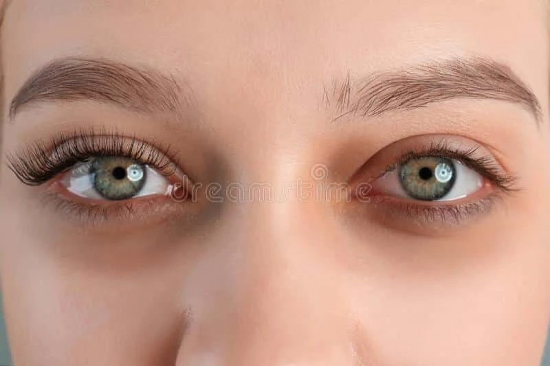 Why Dark Circles Happen: Understanding the Root Causes and How to Treat Them