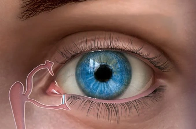 What to Do After a Tear Duct Surgery?