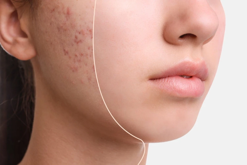 Best Laser Treatment for Acne Scars in Delhi: A Complete Guide to Clearer, Smoother Skin