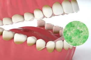 How to Get Rid of Gum Disease for Good