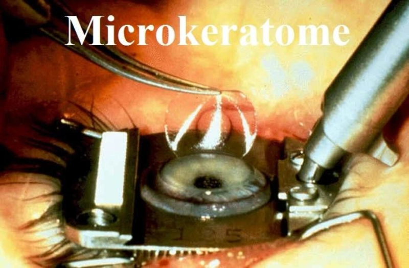 Artisanal Eye Surgery: Mastering the Microkeratome