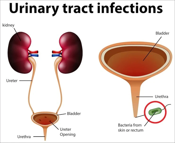 Causes of Urinary Tract Infections (UTIs) and How to Treat Them?