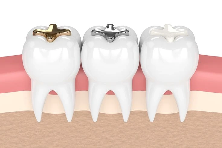 Are Tooth Colored Fillings Painful? What Patients in Ravet Should Expect