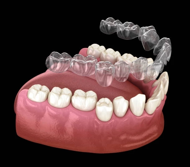 Crystal Clear Confidence: How Porter Ranch Invisalign is Changing the Face of Smiles