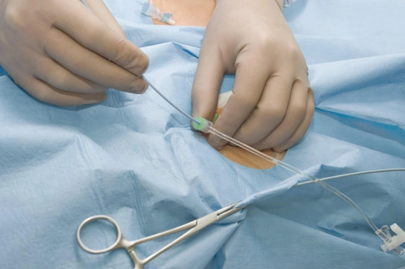 WHAT IS PERITONEAL DIALYSIS?