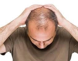 The Ultimate Guide to Hair Patches in Dubai