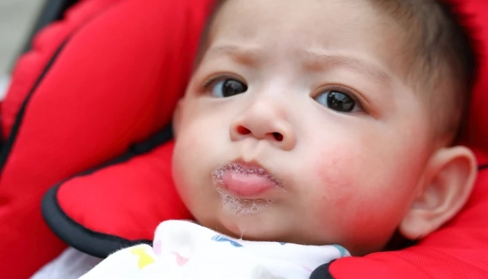 Understanding Drool Rash vs Eczema in Infants and Toddlers