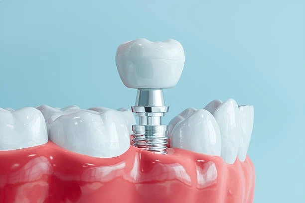 Top Benefits of Dental Implants You Didn’t Know About
