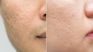 Acne Scar Treatments - The Best Acne Scar Rejuvenation For Beautiful Skin, Quickly