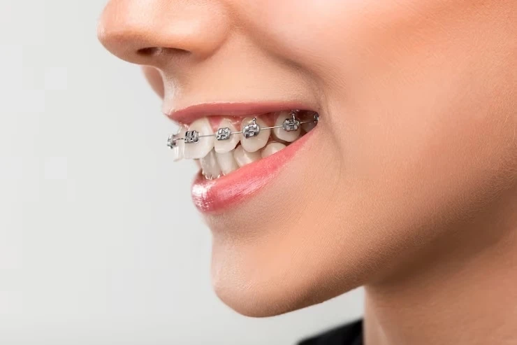 Everything about Braces