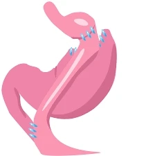 Gastric Bypass Tijuana: How it Works