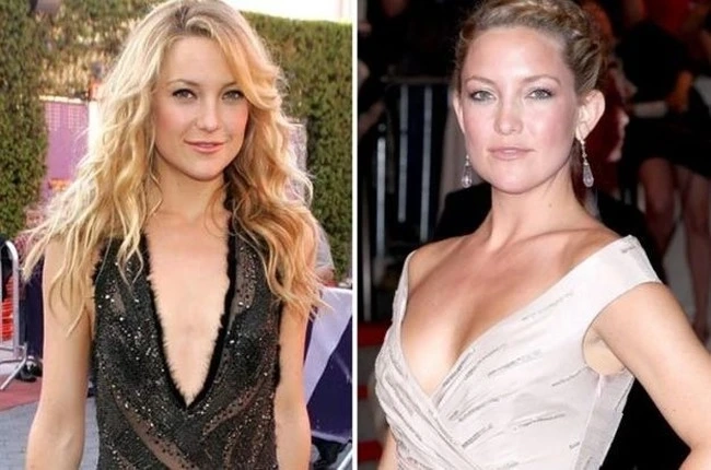 Exploring Kate Hudson Plastic Surgery: Insights and Trends