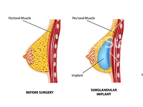 Choosing Between Saline and Silicone Implants: Insights from Clinics