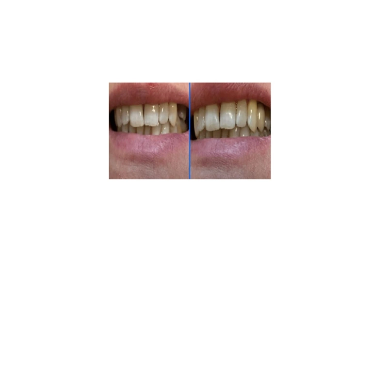Restore Your Smile – Best Dentures Philadelphia
