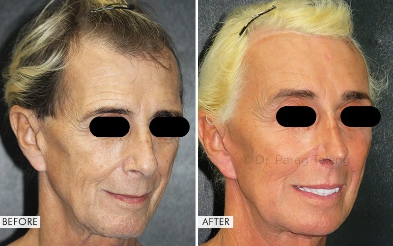 Before and After Facial Feminization Surgery Results  - Dr. Parag Telang