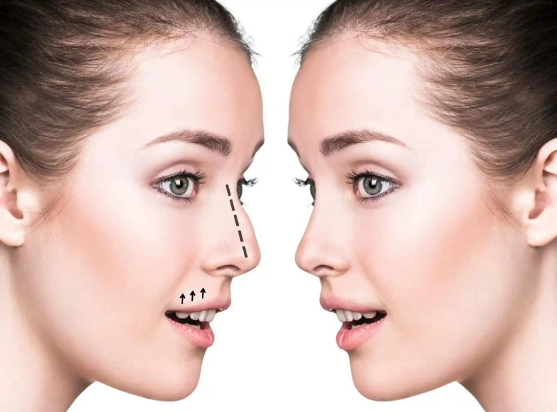 Rhinoplasty in Dubai and Personalized Surgical Design