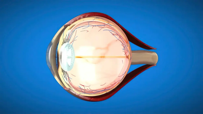 How To Prevent Retina Detachment