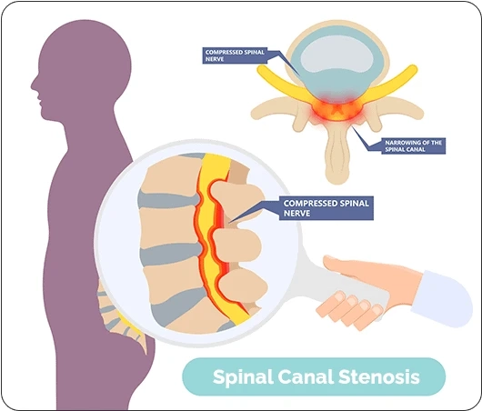 Holistic, Non-Surgical Ways For Spinal Stenosis Treatment