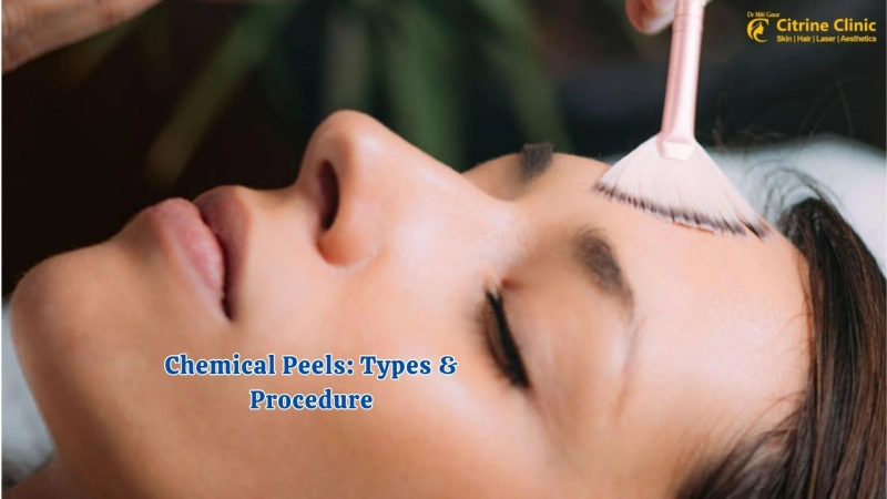 Chemical Peels: Types & Procedure