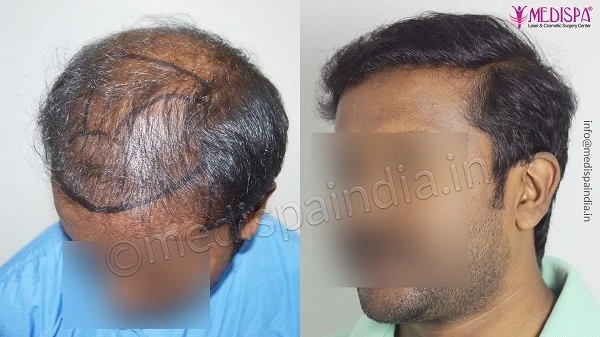 How To Get The Best Hair Transplant Treatment In Pune?