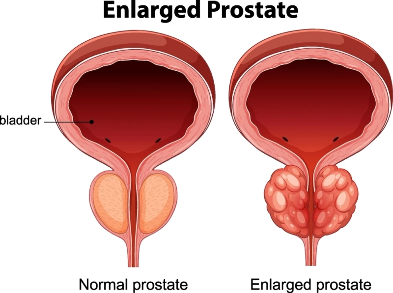 A Practical Guide to Prostate Reduction Treatment in Irvine & Van Nuys