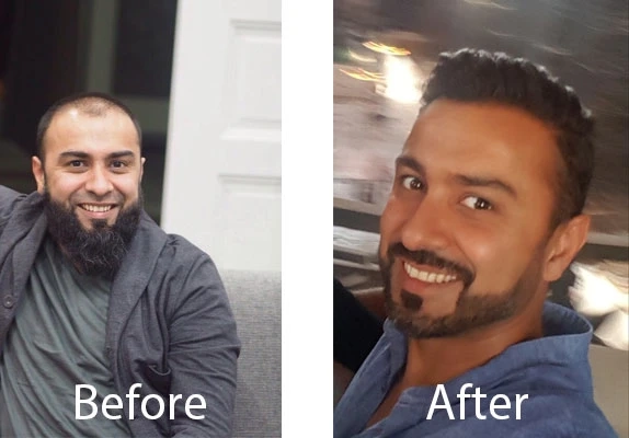 PRP Hair Therapy – A Nonsurgical Hair treatment to Restore Natural Healthy Hairs