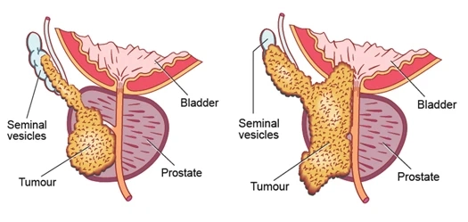 FDA-EMA Approved Drugs for Prostate Cancer: A Comprehensive Guide