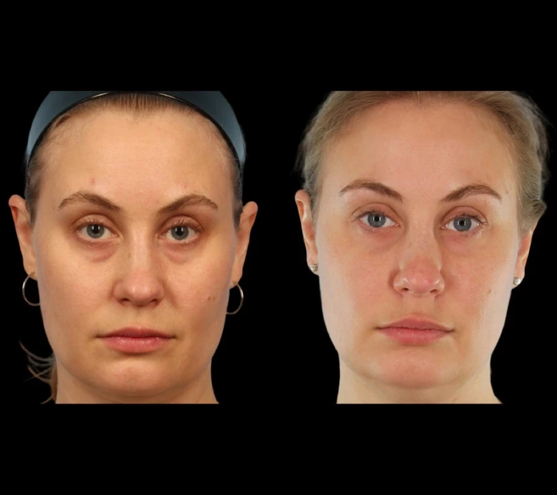 Unique Features of Under Eye Fillers at the Best Aesthetic Clinics in Dubai