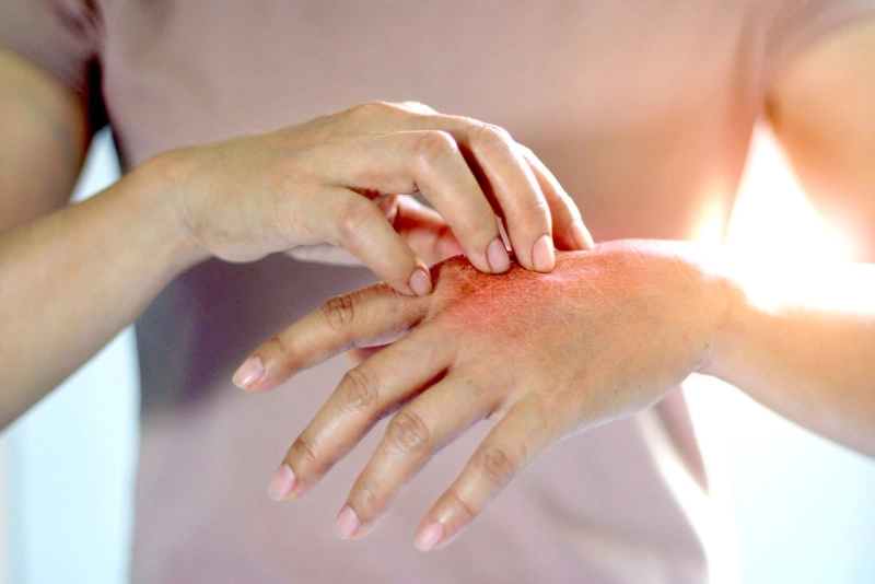 Global Psoriasis Treatment Market Key Developments