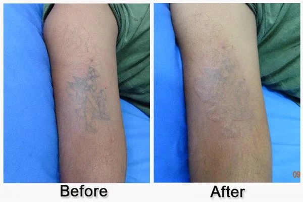 Interval-based laser tattoo removal New York technique
