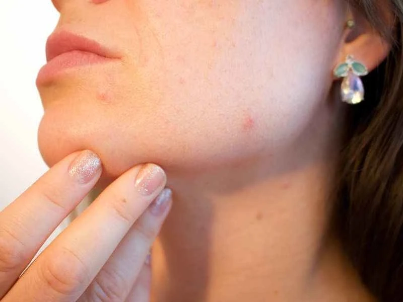 When should You see a Skin Doctor?