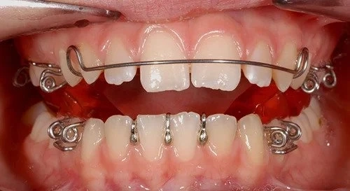 How Dentofacial Orthopedics Can Improve Your Smile