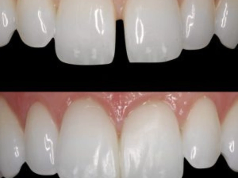 Effective Methods to Correct Teeth Gaps for a Confident Smile