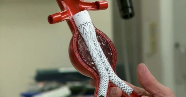 Rising Prevalence and Technological Innovations Shaping the Future of Aortic Aneurysm Repair Industry